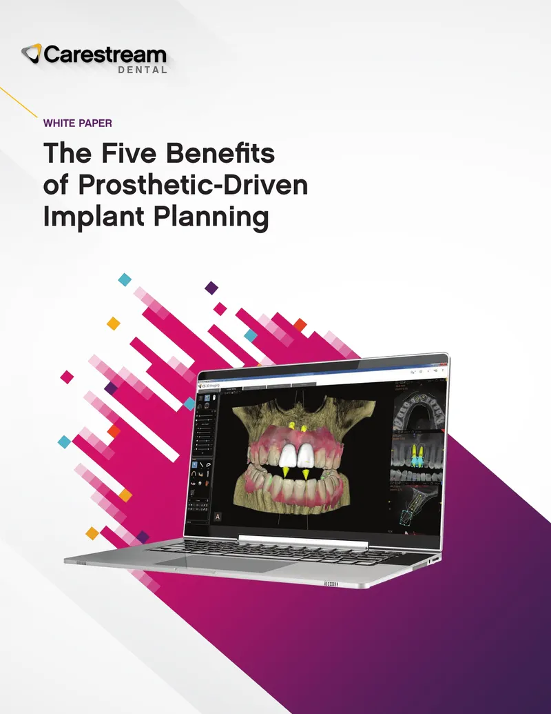 Benefits of Prosthetic-Driven Implant Planning