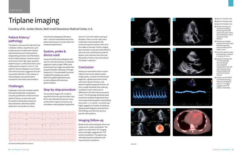 Echocardiographic Assessment of Cardiac Amyloidosis