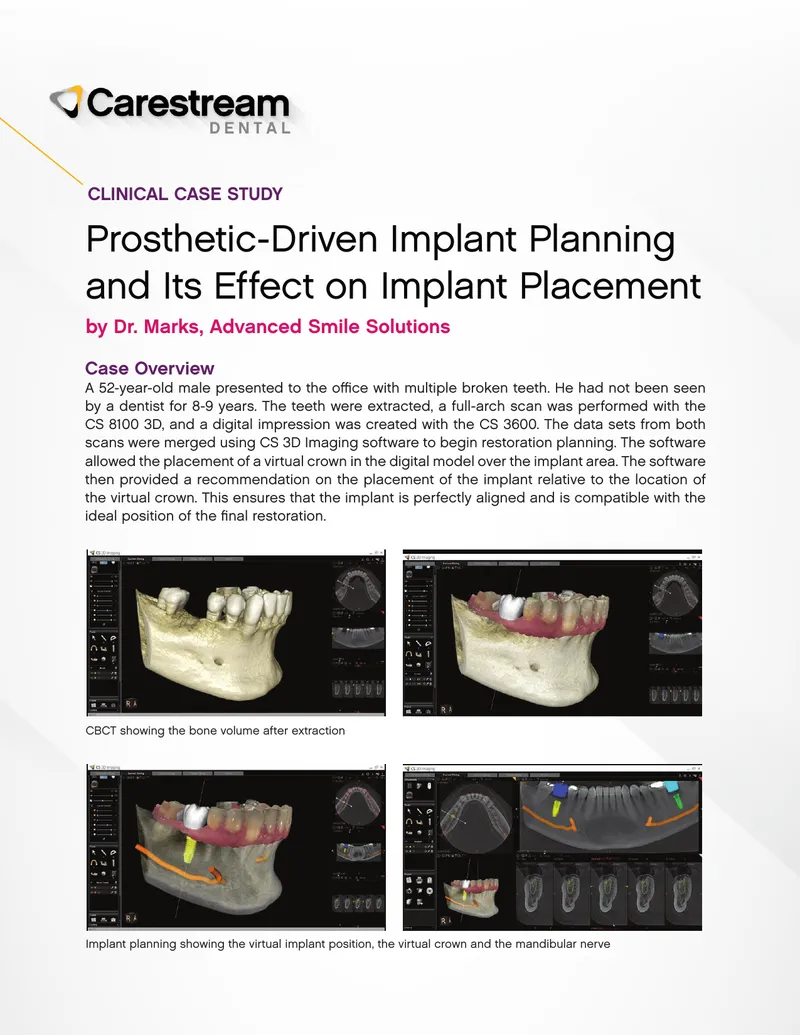 Prosthetic-Driven Implant Planning Case Study