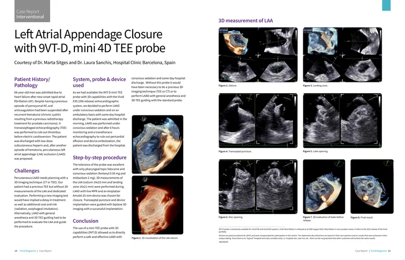Left Atrial Appendage Closure Using 9VT-D Mini TEE Probe