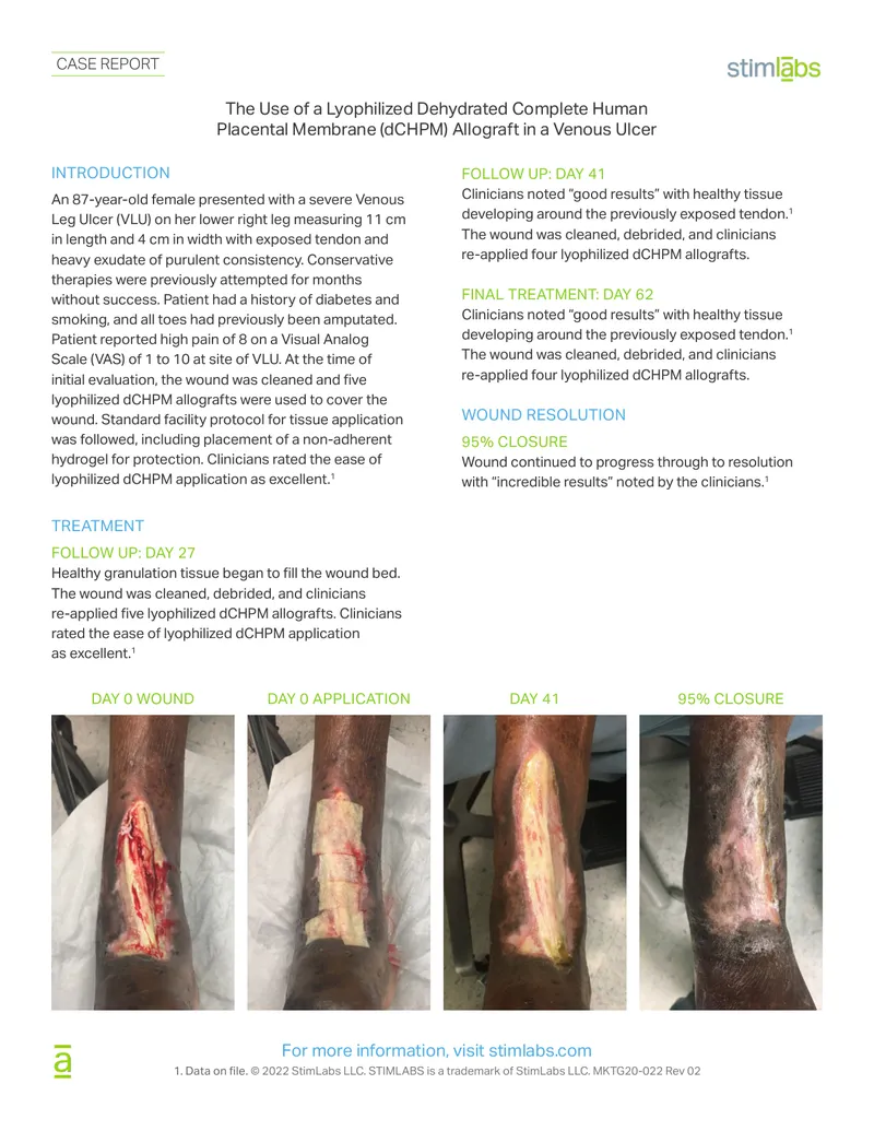 Use of Lyophilized dCHPM Allograft in Venous Ulcer Treatment