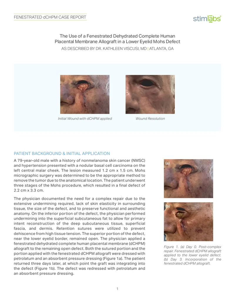 Use of Fenestrated Dehydrated Complete Human Placental Membrane Allograft