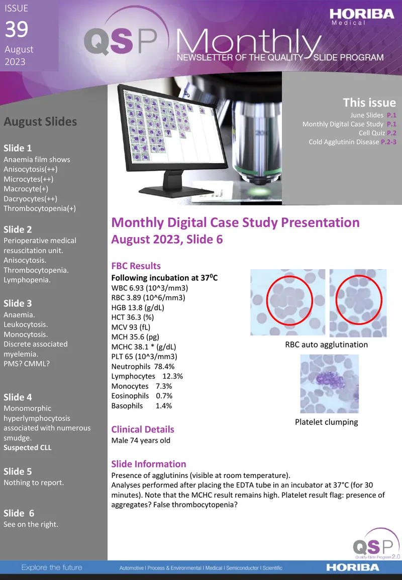 Cold Agglutinin Disease Clinical Presentation and Analysis